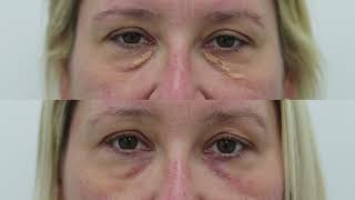 Xanthelasma removal treatment demo and results  see beforeafter photos [upl. by Anomis]