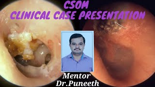 CHRONIC SUPPARATIVE OTITIS MEDIA Clinical case presentation [upl. by Adaminah]