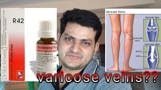 Homeopathic medicine for varicose veins explain [upl. by Iclehc]