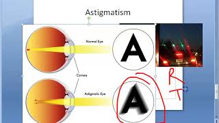 Ophthalmology 044 a Refractive Errors Of Refraction Emmetropia Ametropia Myopia HyperMetropia Eye [upl. by Reltuc]