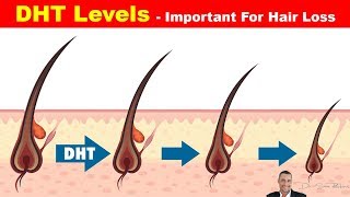 👱 High DHT Affects How Much Hair You Have On Your Head  Hair Loss Part 3 [upl. by Aeslek767]