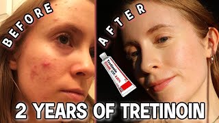 2 YEAR TRETINOIN UPDATE Before amp After Tretinoin Cream 005  My Current Skincare Routine [upl. by Janina395]