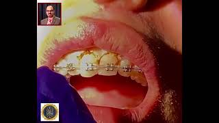 تشكيل ورسم اللثة باستخدام الليزر Reshaping and draw the Gingiva by laser [upl. by Zeret]