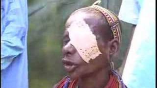 Trachoma  A Devastating Blindness [upl. by Adnawed223]