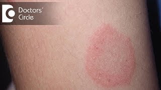 How to manage Chronic Ringworm infection  Dr Rajdeep Mysore [upl. by Analram]