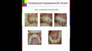 Клиническое применение LMActivator [upl. by Alien]