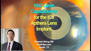 YAG capsulotomy for the IC8 Apthera Lens implant Shannon Wong MD [upl. by Enellek112]