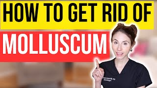 How To Get Rid Of Molluscum FAST  Dermatologist Tips [upl. by Hpesoj]