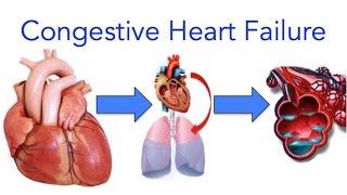 Congestive Heart Failure CHF Explained  MADE EASY [upl. by Halla113]