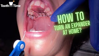 How to turn an Expander at home  Braces Orthodontics  Tooth Time Family New Braunfels [upl. by Trenton280]